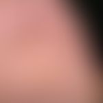 tinea pedum. dyshidrosiform tinea pedum in a 48-year-old athlete, existing for about 12 months. m...