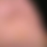 Tinea pedum. Seit etwa 12 Monaten bestehende, dyshidrosiforme Tinea pedum bei einem 48-jährigen L...