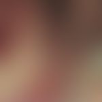 Trichophyton rubrum. Fluoreszenzfärbung: Mikroskopie von Trichophyton rubrum im Nagelmaterial; Fu...