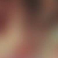 Trichophyton rubrum fluorescence staining: Microscopy of Trichophyton rubrum in nail material; Fu...