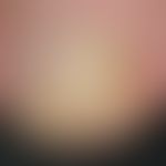 Tinea unguium: distalsubungual onychomycosis. strong, yellowish-white discoloration of the nail m...