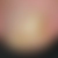 Tinea unguium: distalsubungual onychomycosis. strong, yellowish-white discoloration of the nail m...
