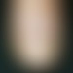 Tinea unguium: distal, yellow-brown subungual discoloration with dystrophy of the nail in a 68-ye...