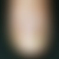 Tinea unguium: distal, yellow-brown subungual discoloration with dystrophy of the nail in a 68-ye...