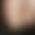 Tinea unguium; distal subungual type of onychomycosis; starting from the hyponychium there is a s...