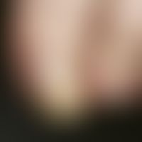 Tinea unguium; distal subungual type of onychomycosis; starting from the hyponychium there is a s...