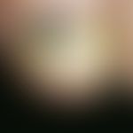 Tinea unguium. in the distal part of the nail matrix a large-area, colorful, not painful nail dis...