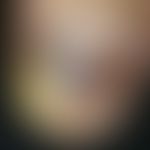 Tinea unguium. dystrophic onychomycosis. colorful, not painful nail discoloration (yellow-blue-gr...
