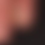 Tinea unguium: Distal onychomyksoe with striped yellow-brown nail dystrophy; chronic non-painful ...