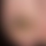 Tinea unguium. distal onychomycosis with crumbly destruction of the nail matrix. aphlegmatic tine...