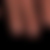 Tinea unguium:almost complete onychodystrophy of all fingernails; patient with insulin-dependent ...