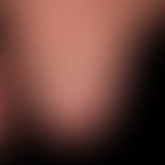 Tinea unguium. years of distal onychomycosis which has led to an almost complete destruction of t...