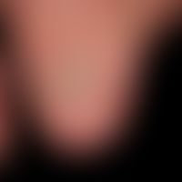 Tinea unguium. years of distal onychomycosis which has led to an almost complete destruction of t...