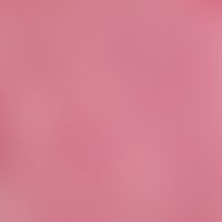Muir-Torre-Syndrom. Scharf begrenzter, dermaler Adnextumor mit erhaltener lobärer Struktur der Ta...