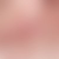 transient acantholytic dermatosis. detail enlargement from previous overview. initial papules, ab...