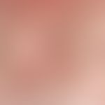 Transitorische akantholytische Dermatose. Seit 6-8 Wochen langsam progredientes mäßig juckendes, ...