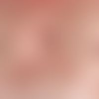 Transitory acantholytic dermatosis. 6-8 weeks of slowly progressive moderately pruritic, truncal ...