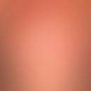 Transitorische akantholytische Dermatose (M.Grover): seit wenigen Wochen bestehendes, nur mäßig s...