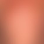 Transitorische akantholytische Dermatose (M.Grover): seit wenigen Wochen bestehendes, nur mäßig s...