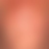Transitory acantholytic dermatosis (M.Grover): a few weeks old, only moderately pruritic clinical...