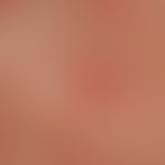 Transitorische akantholytische Dermatose (M.Grover): Detailaufnahme
