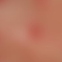 Transitory acantholytic dermatosis (M.Grover): detailed picture
