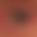 Trichiasis bei chronischem Lidekzem. Siehe am unteren Lidrand die auffällige Verdopplung der Wimp...