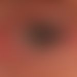 Trichiasis in chronic eyelid eczema. See the conspicuous doubling of the eyelashes at the lower l...