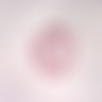 Trichinose. Trichinella spiralis. Die adulten Würmer leben im Dünndarm und werden bis zu 3,5 mm g...