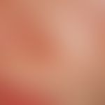 Trichoepitheliome:&nbsp;prall-elastische&nbsp;hautfarbene&nbsp;Knötcehn und Knoten&nbsp; im Berei...
