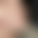 Tricholemmom. Solitärer derber, halbkugelig vorgewölbter, rötlicher Knoten an der Nasenspitze.