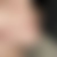 Tricholemmom. Solitärer derber, halbkugelig vorgewölbter, rötlicher Knoten an der Nasenspitze.