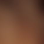 Trichorrhexis nodosa: Broken, splintered hairs that are difficult to comb and hairs with fine, sh...