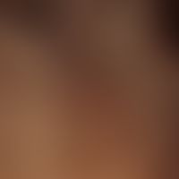 Trichorrhexis nodosa: Broken, splintered hairs that are difficult to comb and hairs with fine, sh...