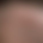 trichotillomania. severely thinned hair with healthy scalp and intact follicular structure. scrat...