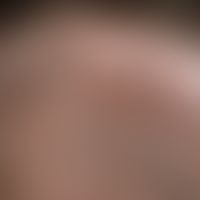 trichotillomania. severely thinned hair with healthy scalp and intact follicular structure. scrat...