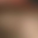 Trichotillomanie. Seit 2 Jahren in unterschiedlicher Ausdehnung auftretende, umschriebene, flächi...