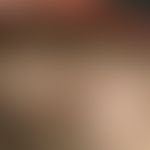 Trichotillomania. since 2 years in different extension occurring, circumscribed, laminar bald pat...
