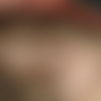 Trichotillomania. since 2 years in different extension occurring, circumscribed, laminar bald pat...