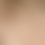Trichotillomania: Hair follicles with missing or even single hair tufts that can be recognized wi...