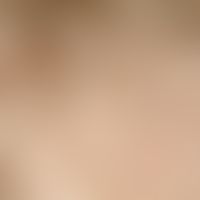 Trichotillomania: Hair follicles with missing or even single hair tufts that can be recognized wi...