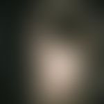 trichotillomania. circumscribed bald patches (tonsur-like) in the area of the head hair. artifici...