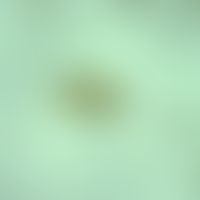 Trichuriasis. egg of Trichuris trichiura. typical are the bipolar, lemon-shaped eggs, which are b...