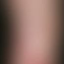 Tuberculosis cutis colliquativa. Schmerzlose, livid-rote, kutane und subkutane Knoten, die zur Ul...