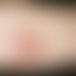 Tuberculosis cutis luposa. Rötlich-bräunliches Infiltrat mit groblamellärer Schuppung, seit 9 Mon...