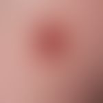 Tuberculosis cutis luposa. Münzgroßer, gelb-bräunlich infiltrierter Knoten mit atrophischer Oberf...