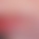 Tuberculosis cutis luposa. Partiell abgeheilter und vernarbter Herd im Bereich der Unterlippe. We...
