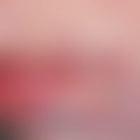tuberculosis cutis luposa. partially healed and scarred focus in the area of the lower lip. furth...