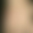 Tuberculosis cutis verrucosa: Centrifugally growing, painless, scaly and crusty, verrucous, blurr...
