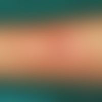 Tuberkulinreaktion. Blasige Typ IV-Reaktion auf Tuberkulin (nach 72 Stunden) im Bereich des Unter...
